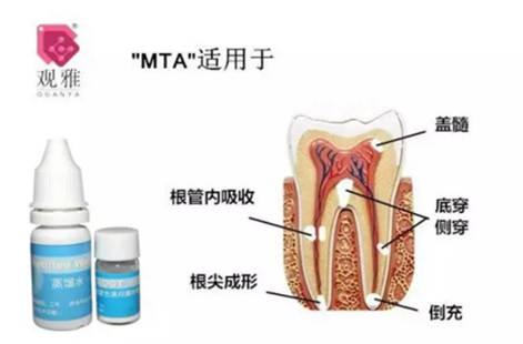 “觀雅”MTA修補(bǔ)側(cè)穿一例