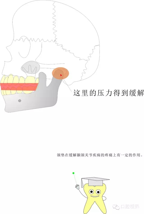 【愛牙科普知識300問】 “什么是頜（牙）墊？”