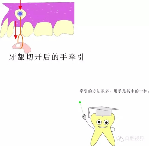 【愛牙科普知識300問】 “什么是頜（牙）墊？”