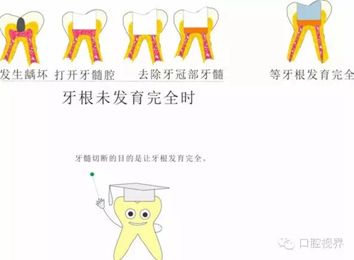 【愛牙科普知識300問】 “什么是活髓切斷術？”