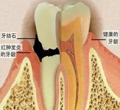 【愛牙科普】口腔謠言終結(jié)者——每天刷牙，洗牙該不該？！