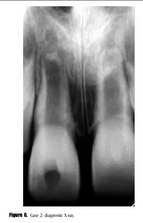 病例分享｜牙髓血管再生治療失敗后的牙根發(fā)育：2例