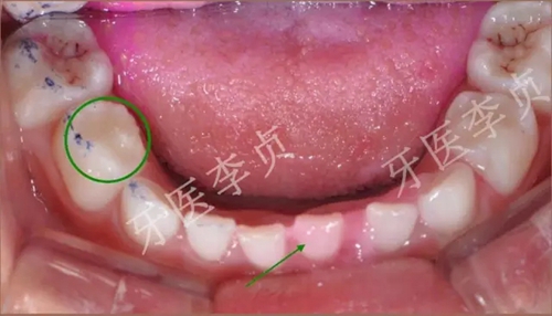 兒牙病例|兒童蛀牙的修復(fù)