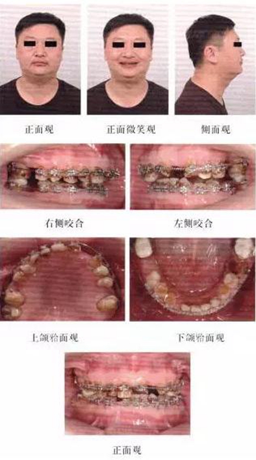 正畸修復(fù)聯(lián)合咬合重建1例 