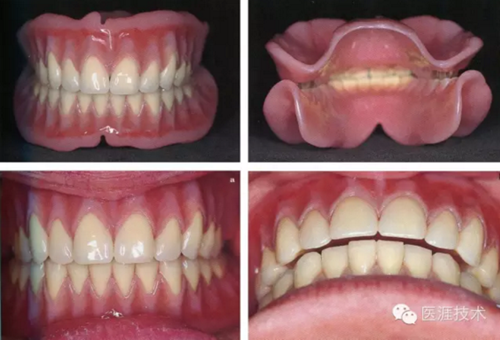 全口拔牙即戴全口活動義齒修復病例 