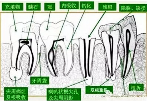 根管治療之根管口的探查要點(diǎn)  