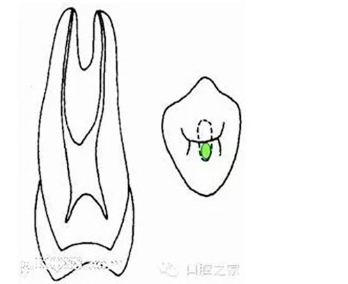 根管治療之根管口的探查要點(diǎn)  