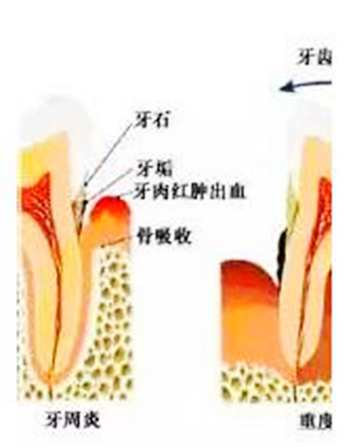 根管治療圖譜