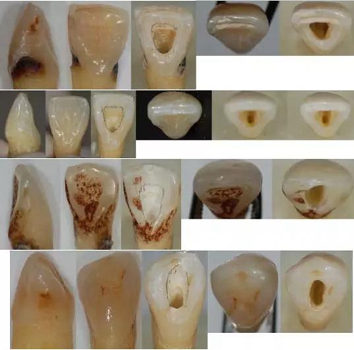 各牙齒的大概的開髓形態(tài)