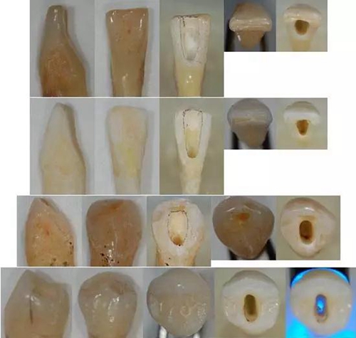 各牙齒的大概的開髓形態(tài)