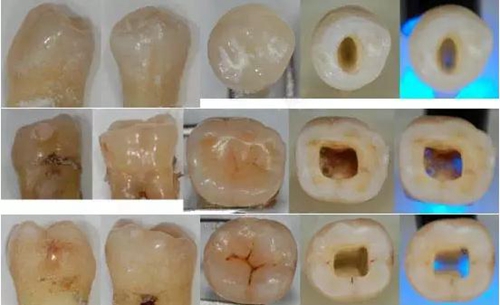 各牙齒的大概的開髓形態(tài)