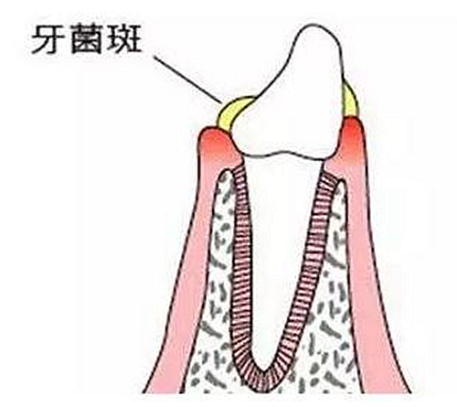 牙周病患者的外提升 梁光強