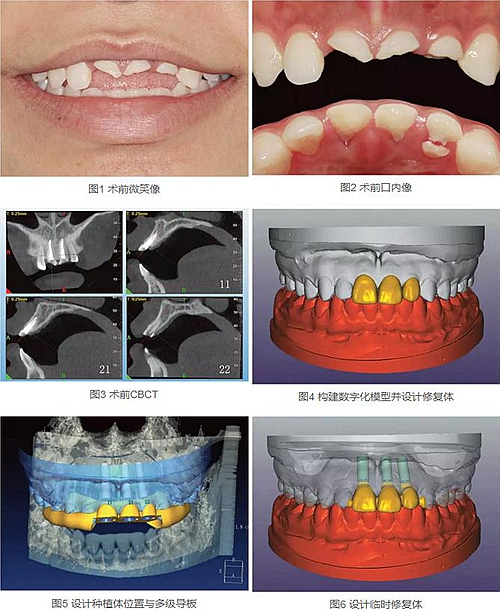 上頜多顆相鄰前牙的“精確化”即刻種植修復