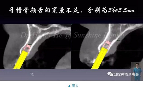 短種植體在前牙美學(xué)區(qū)應(yīng)用的臨床病例報(bào)道（上）