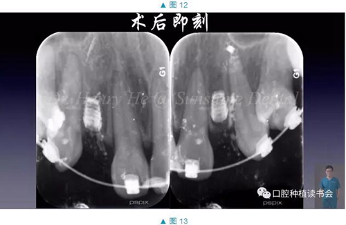 短種植體在前牙美學(xué)區(qū)應(yīng)用的臨床病例報(bào)道（上）