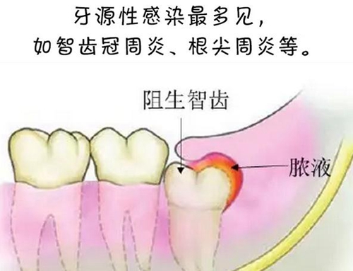 警惕！牙疼引發(fā)的間隙感染很危險(xiǎn)