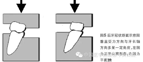 凸凹式后牙咬合接觸及其臨床意義——王美青教授