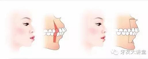 12歲前必須處理的20種兒童牙頜畸形【口腔科普】