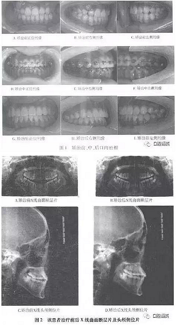 尖牙完全唇側(cè)錯(cuò)位擁擠，矯正1例  