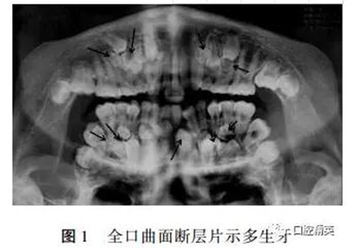 罕見(jiàn)多發(fā)性14顆多生牙1例