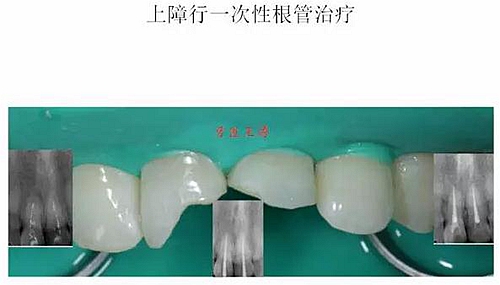 前牙外傷冠延長+全瓷冠修復