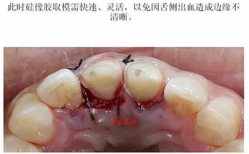 前牙外傷冠延長+全瓷冠修復