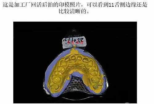 前牙外傷冠延長+全瓷冠修復