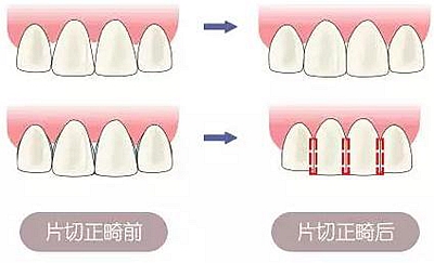 醫(yī)生方案里的鄰面去釉，究竟是什么？