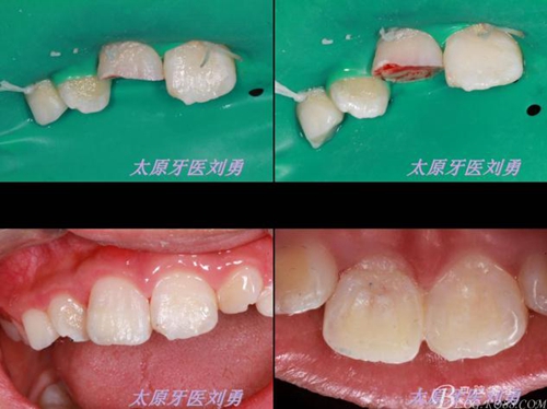 劉勇：斷牙再粘結(jié)兩例病例 