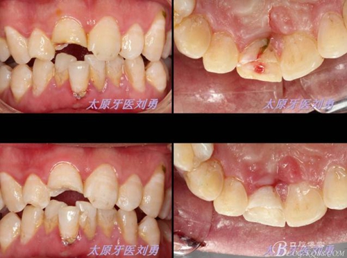 劉勇：斷牙再粘結(jié)兩例病例 