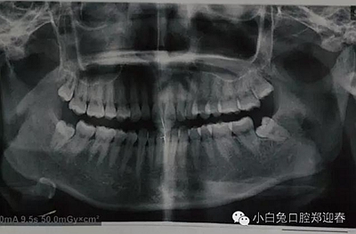 (原創(chuàng))//圖解微創(chuàng)舒適拔牙全過程 