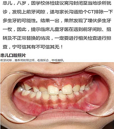 多生牙的拔除總原則：早發(fā)現(xiàn)，早處理！