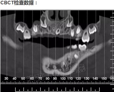 多生牙的拔除總原則：早發(fā)現(xiàn)，早處理！