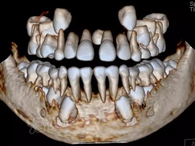 多生牙的拔除總原則：早發(fā)現(xiàn)，早處理！