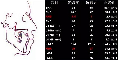 種植釘多維運(yùn)用矯正高角反頜及開頜—對(duì)羅晨醫(yī)生專訪及病例展示（上）