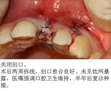 種植失敗的骨增量處理一例 