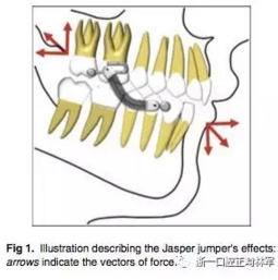 正畸文獻閱讀--用Jasper跳躍矯治器治療II類患者的長期穩(wěn)定性