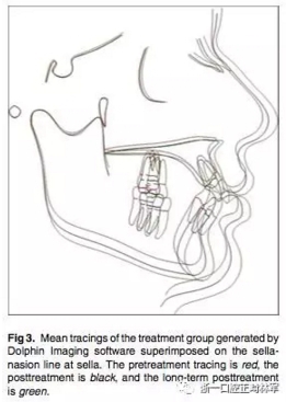 正畸文獻閱讀--用Jasper跳躍矯治器治療II類患者的長期穩(wěn)定性