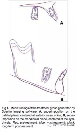 正畸文獻閱讀--用Jasper跳躍矯治器治療II類患者的長期穩(wěn)定性
