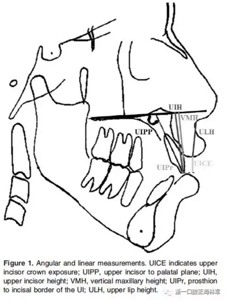 正畸文獻(xiàn)閱讀--在骨性II、III類(lèi)開(kāi)合中上中切牙牙冠暴露量的影響因素