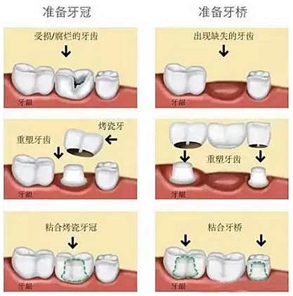 一位資深牙醫(yī)的總結(jié) | 如何減輕患者鑲牙后酸痛癥狀的措施！