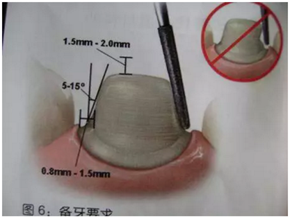 醫(yī)生，我的烤瓷牙上有個黑線怎么回事？