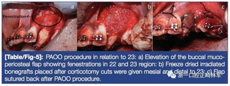 文獻(xiàn)優(yōu)秀正畸病例賞析--牙周加速成骨正畸（PAOO）輔助的腭側(cè)埋伏尖牙牽引矯治及5年跟蹤隨訪