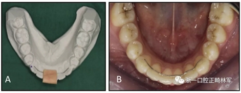 正畸文獻閱讀--兩種舌側(cè)保持器弓絲在下頜牙弓保持中的臨床效果比較