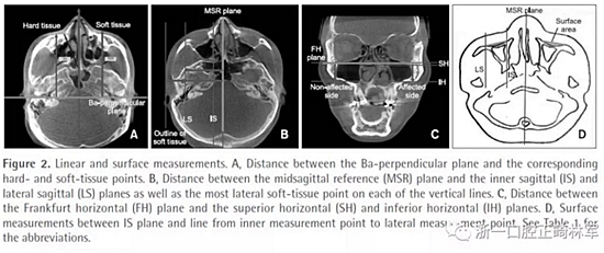 正畸文獻閱讀--無癥狀單側(cè)唇腭裂患者面中部不對稱的三維分析