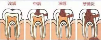 當(dāng)心“腹黑”齲齒，牙齒有個(gè)小洞也要補(bǔ)！