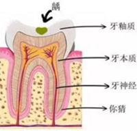 當(dāng)心“腹黑”齲齒，牙齒有個(gè)小洞也要補(bǔ)！