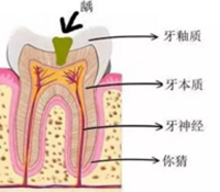 當(dāng)心“腹黑”齲齒，牙齒有個(gè)小洞也要補(bǔ)！