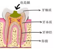 當(dāng)心“腹黑”齲齒，牙齒有個(gè)小洞也要補(bǔ)！