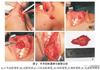 面頰部皮樣囊腫伴皮瘺1例報道